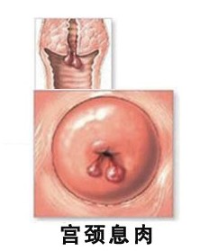 宮頸息肉的(de)症狀